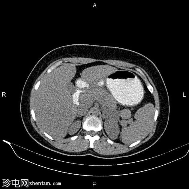 急性胰腺炎