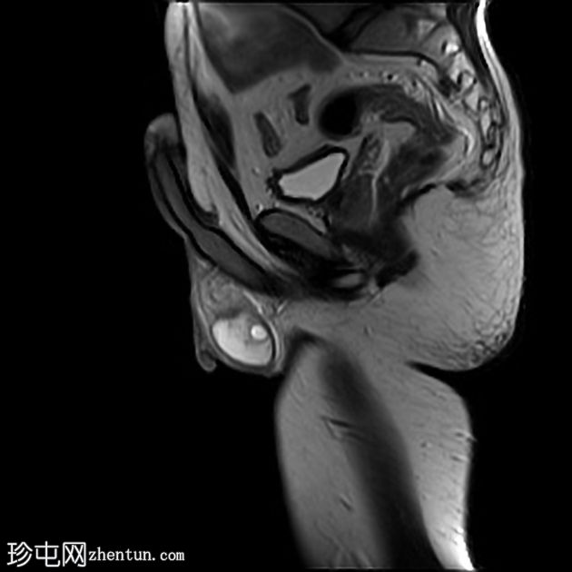 睾丸脓肿