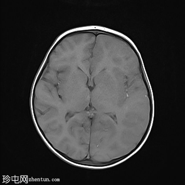 偏瘫-抽搐性癫痫综合征