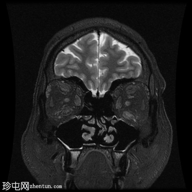 甲状腺相关眼眶病