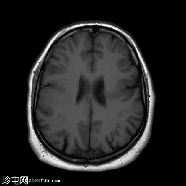 裂脑畸形-闭唇型
