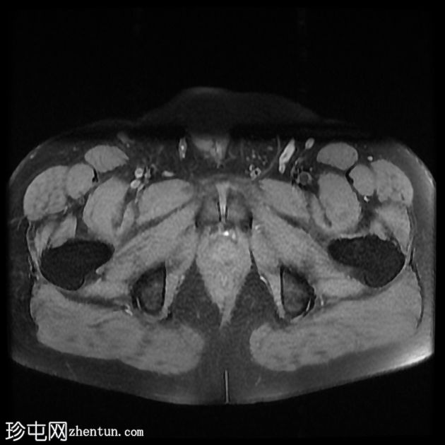 含脂肪的腹股沟阴囊疝