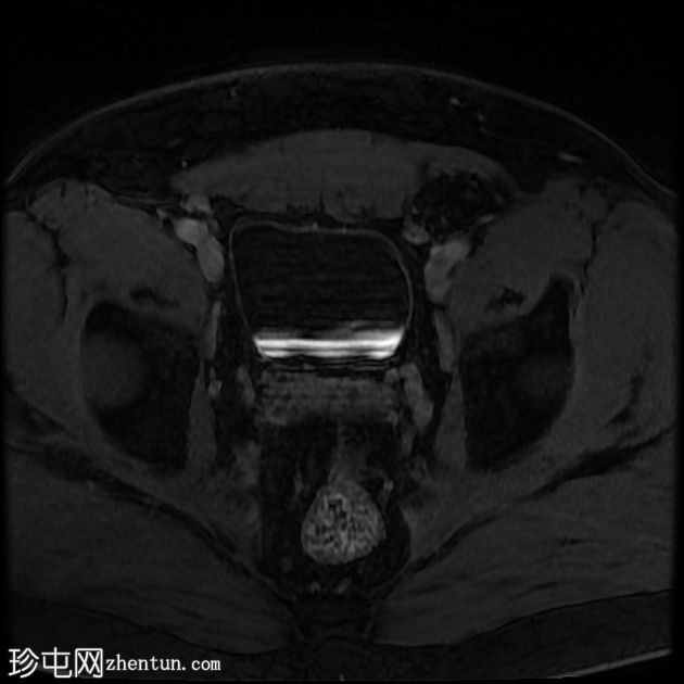 含脂肪的腹股沟阴囊疝