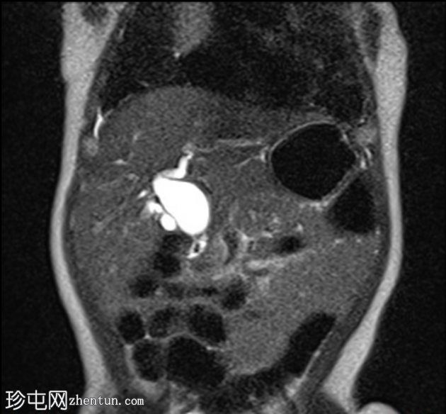 胆总管囊肿