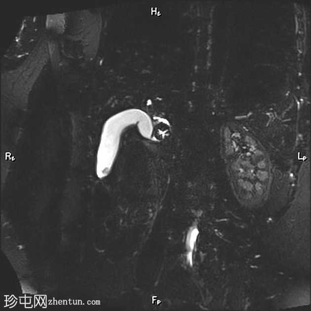 胆结石的Mercedes-benz征 - MRI