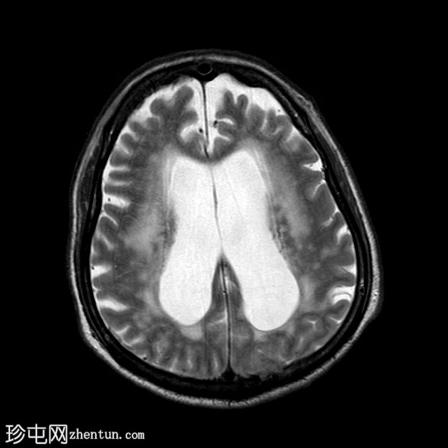 正常压力脑积水和淀粉样血管病