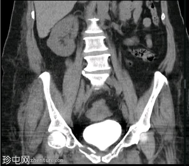 膀胱CT造影正常值