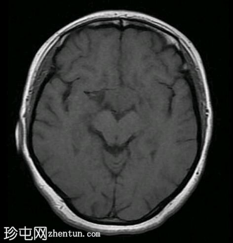 垂体大腺瘤