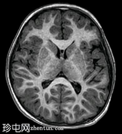 小脑桥脑发育不全