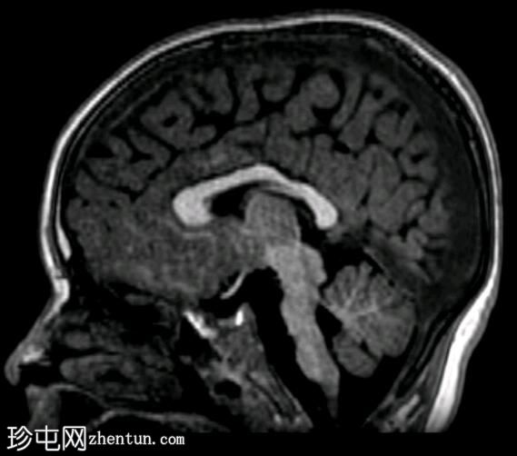 小脑桥脑发育不全