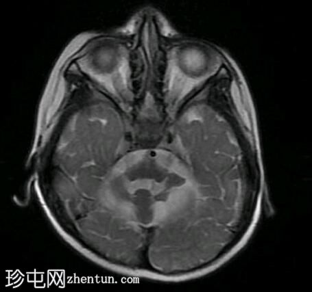 小脑发育不全-蜻蜓征