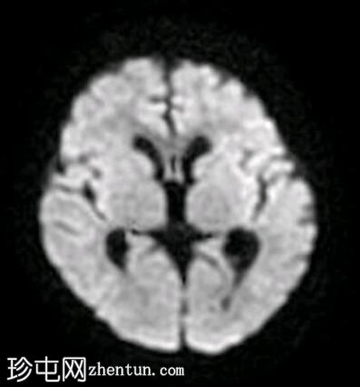 小脑发育不全-蜻蜓征