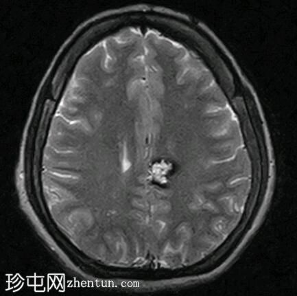 脑海绵状静脉畸形