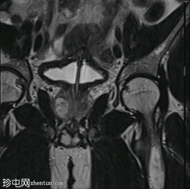 前列腺脓肿