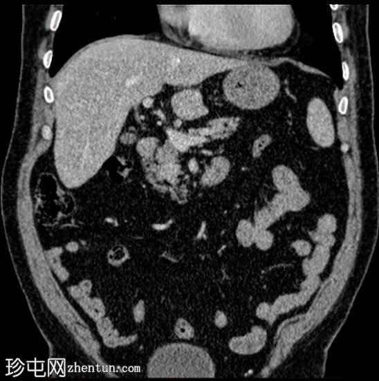 胰腺神经内分泌肿瘤