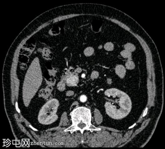 胰腺神经内分泌肿瘤