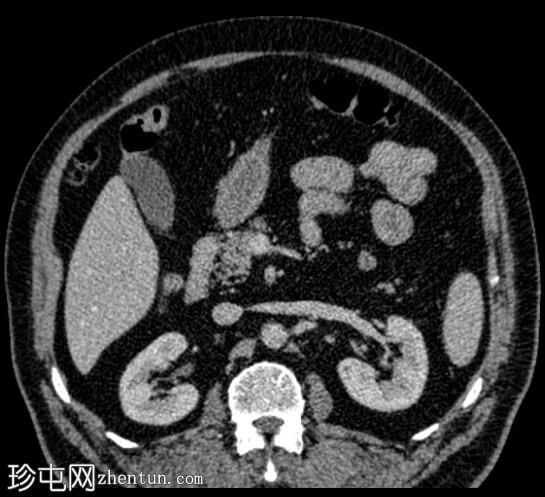 胰腺神经内分泌肿瘤