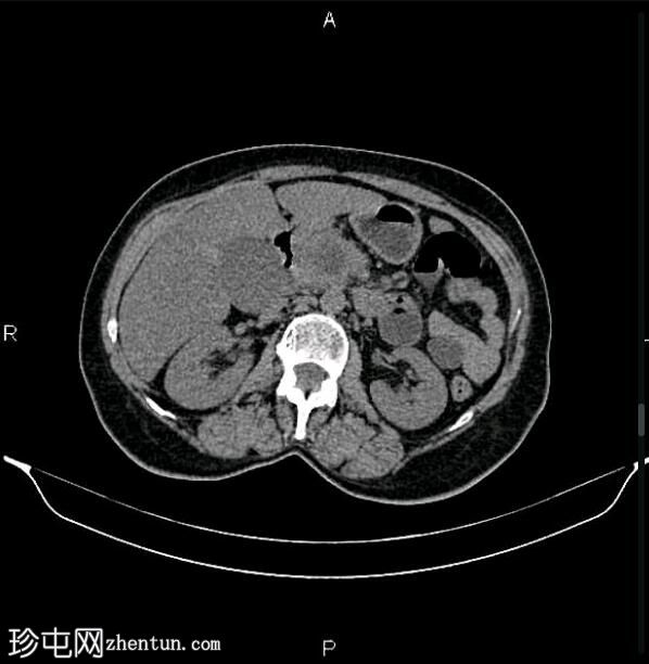 胰腺导管腺癌