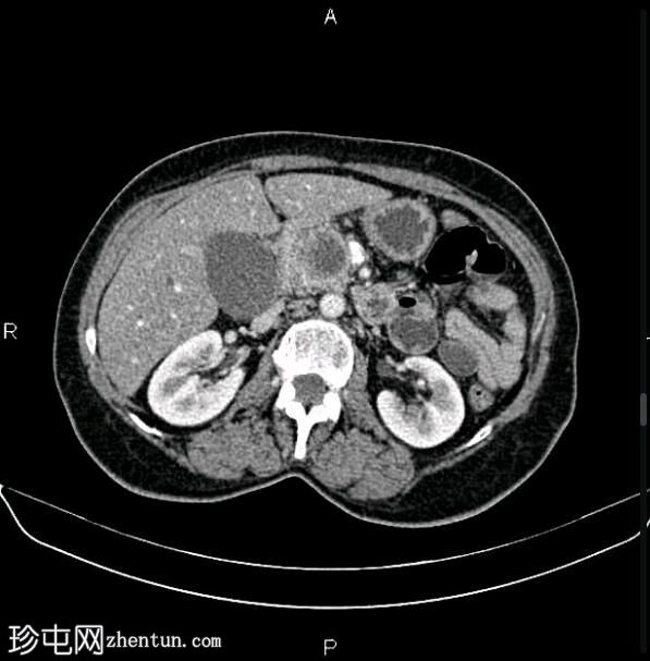 胰腺导管腺癌