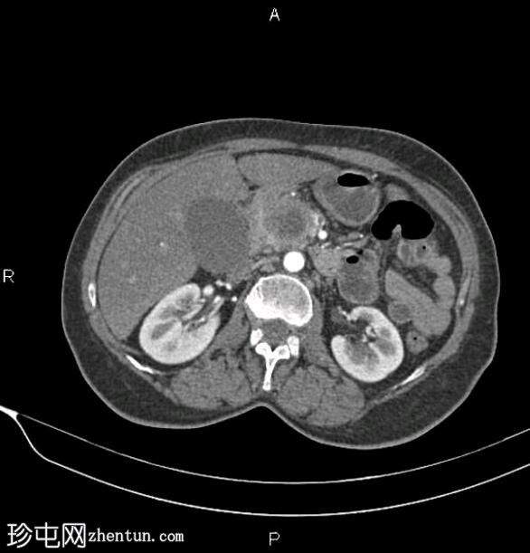 胰腺导管腺癌