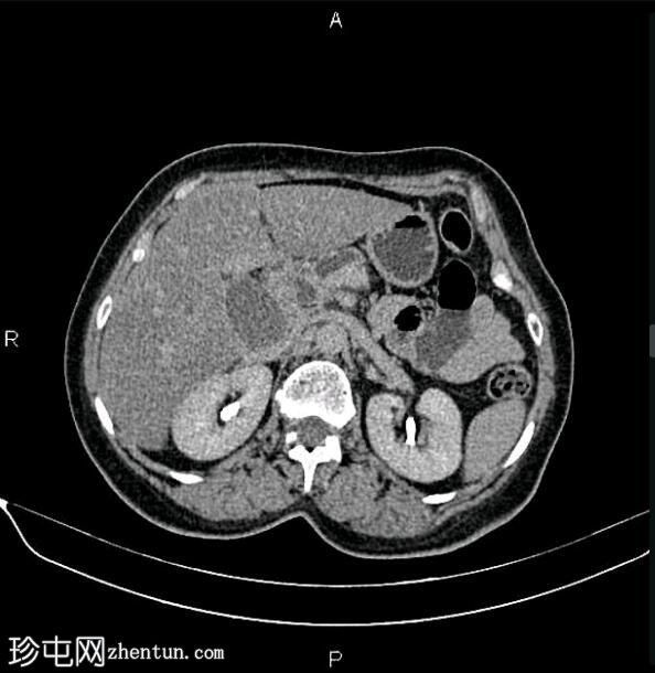 胰腺导管腺癌