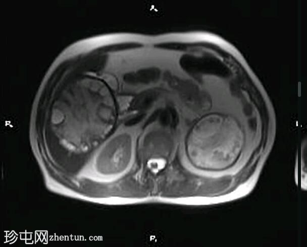 肝肾包虫囊肿