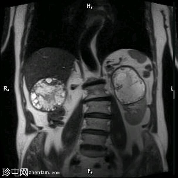 肝肾包虫囊肿