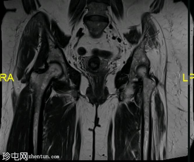 坐骨股骨撞击症