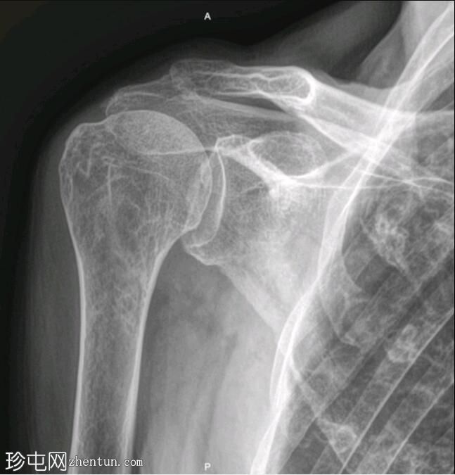 全层肩袖撕裂
