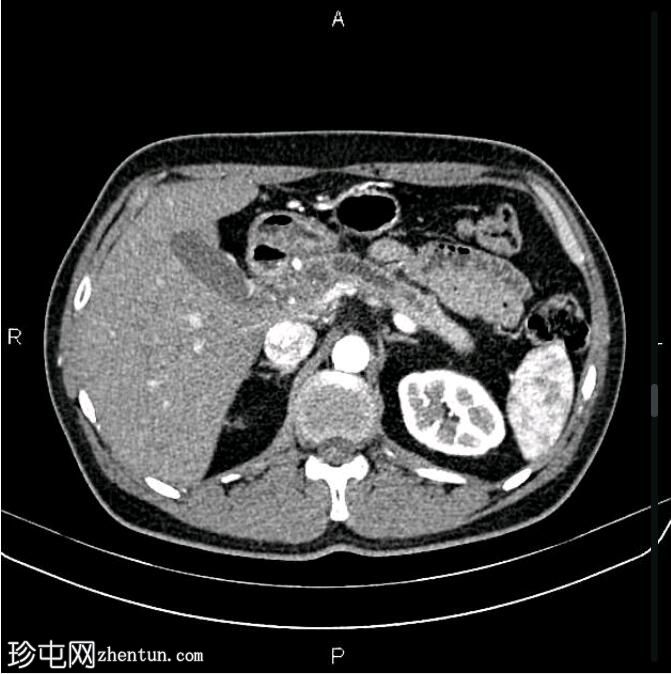 慢性胰腺炎伴假性囊肿