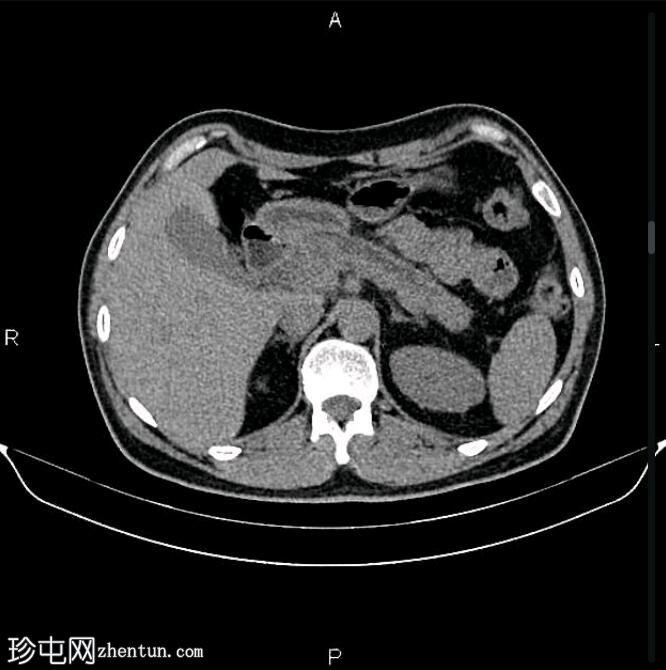 慢性胰腺炎伴假性囊肿