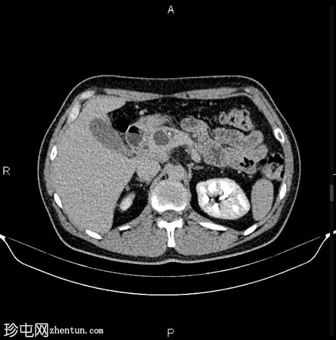 慢性胰腺炎伴假性囊肿
