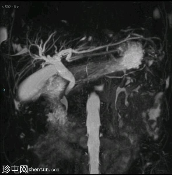 壶腹部继发性肿瘤