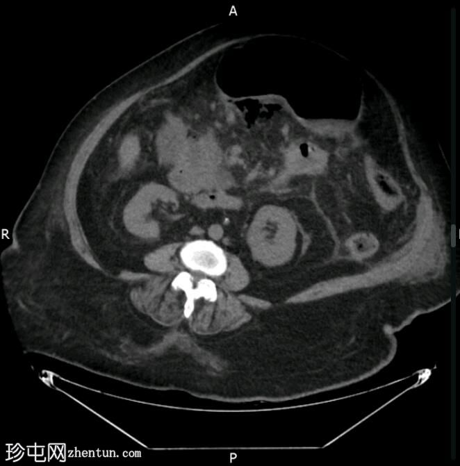 气肿性坏死性胰腺炎